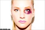 Heather Morris' Black Eye Photos Draw Controversy, Tyler Shields Clarifies