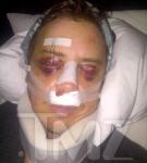 Jason London Recovering From Facial Reconstructive Surgery