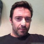 Hugh Jackman Gets Skin Cancer on His Nose Removed