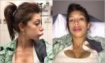 Farrah Abraham Gets Her Upper Lip Enlarged Following Botched Lip Injections