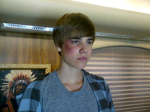 justin bieber csi episode name. Justin Bieber Sports Black Eye
