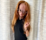 YouTube Star Adalia Rose Williams Died at Age 15 Weeks After Losing Hearing