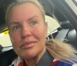 Kerry Katona in So Much Pain After Accidentally Poking 'Bloody Eye' Following Eyelid Surgery