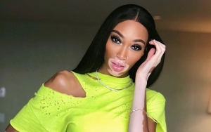 Winnie Harlow Clarifies Her Controversial 'ANTM' Comments