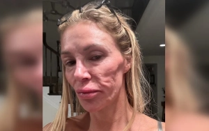 Brandi Glanville Says She Has Parasite on Her Face After Showing Severe Skin Condition
