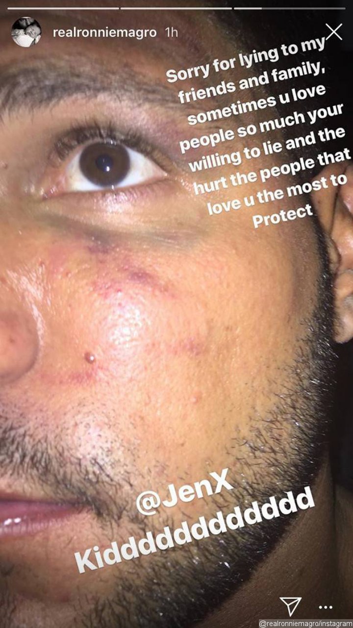 Ronnie Ortiz-Magro Black Eye