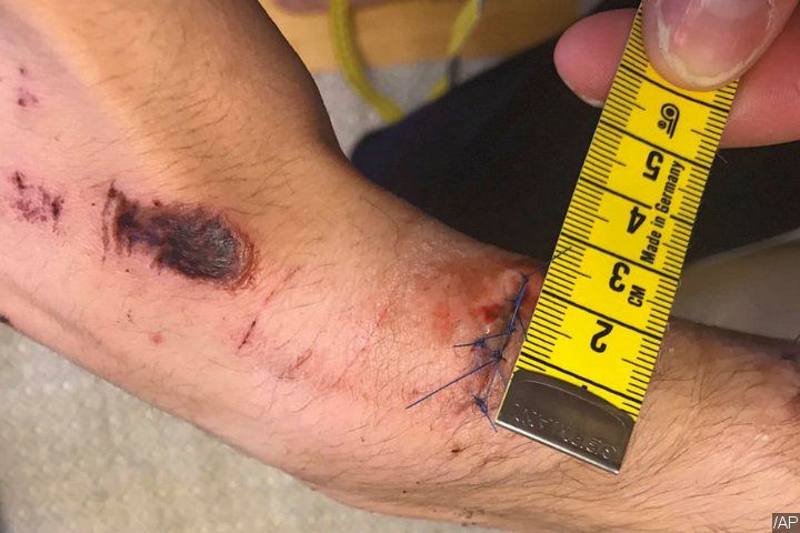 Photo of A$AP Rocky's Alleged Victim's Injuries