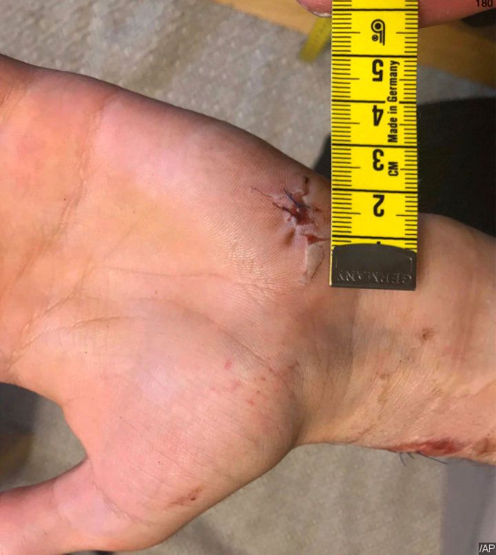 Photo of A$AP Rocky's Alleged Victim's Injuries