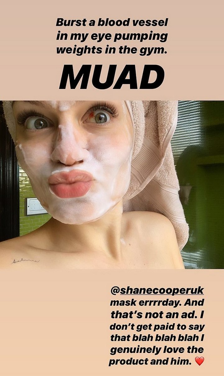 Jessie J has a bloody eye