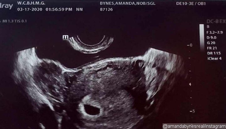 Amanda Bynes Announces Pregnancy