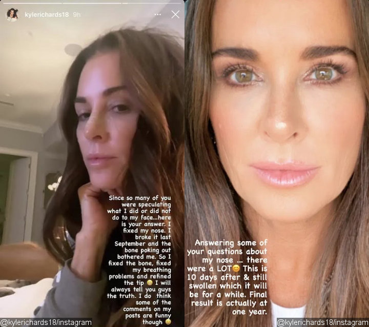Kyle Richards Claims Her Husband Is Happy With the Result of Her Nose Job