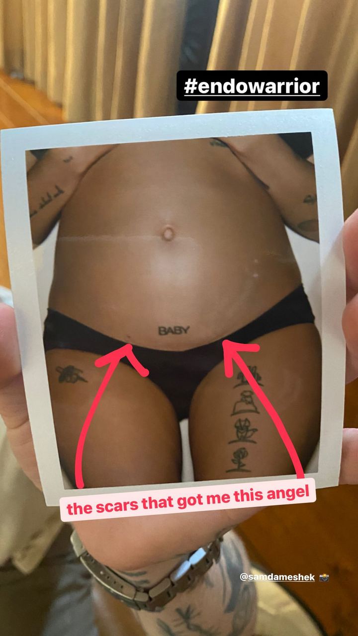 Halsey shows off surgery scars