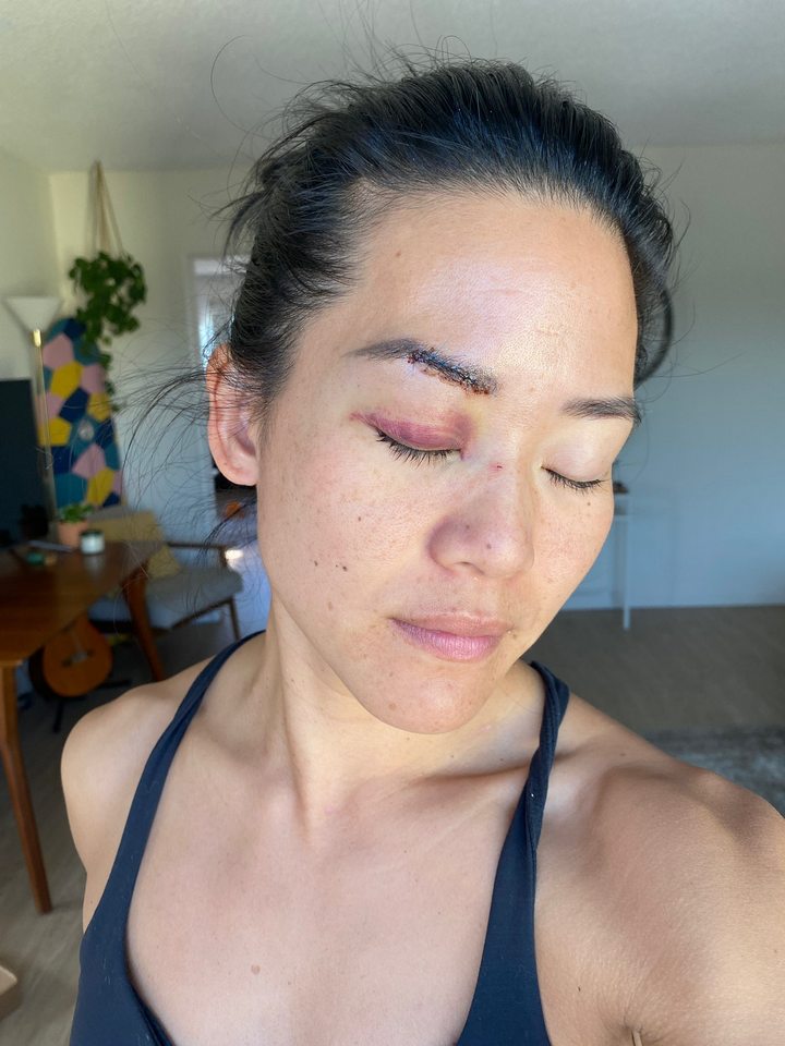 Michelle Yi injured after being attacked in Santa Monica