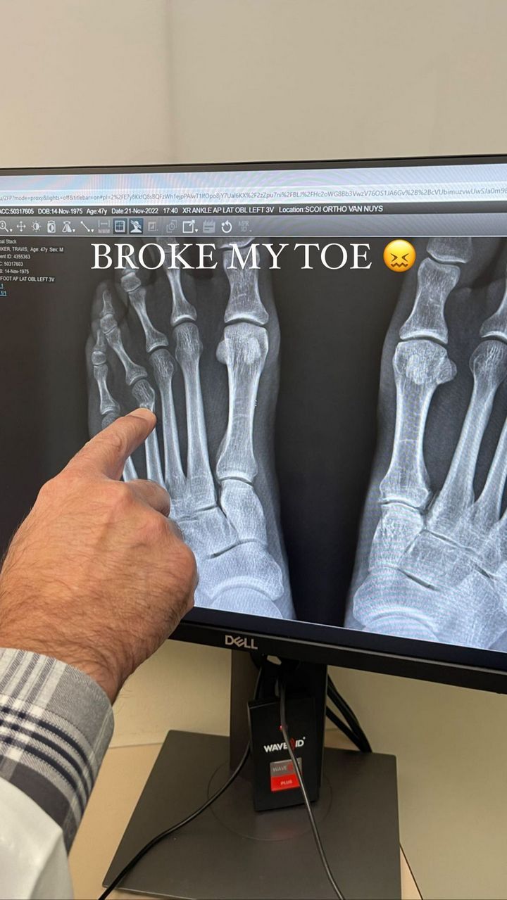 Travis Barker shows X-ray image of his broken toe