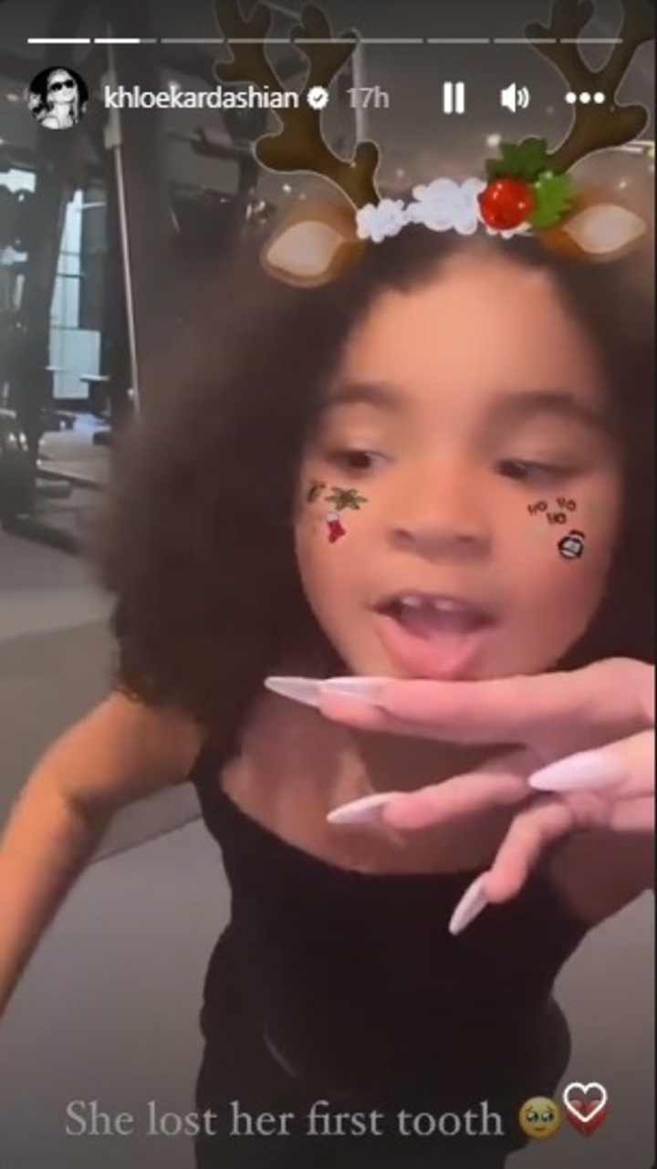 True Thompson shows off her tooth gap