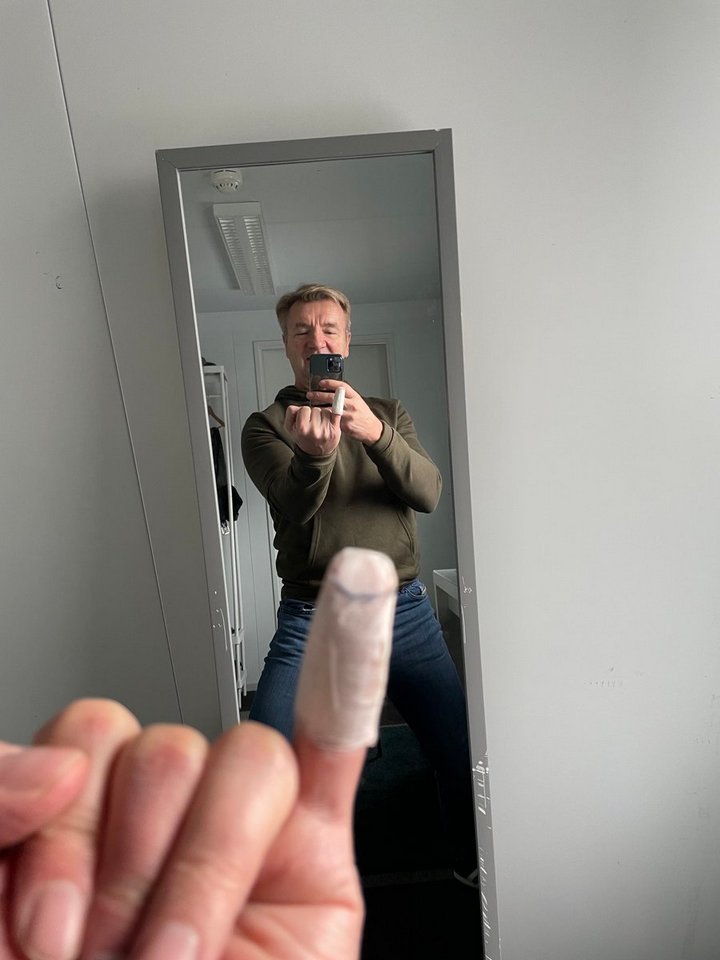 Christopher Dean shows off his injured finger