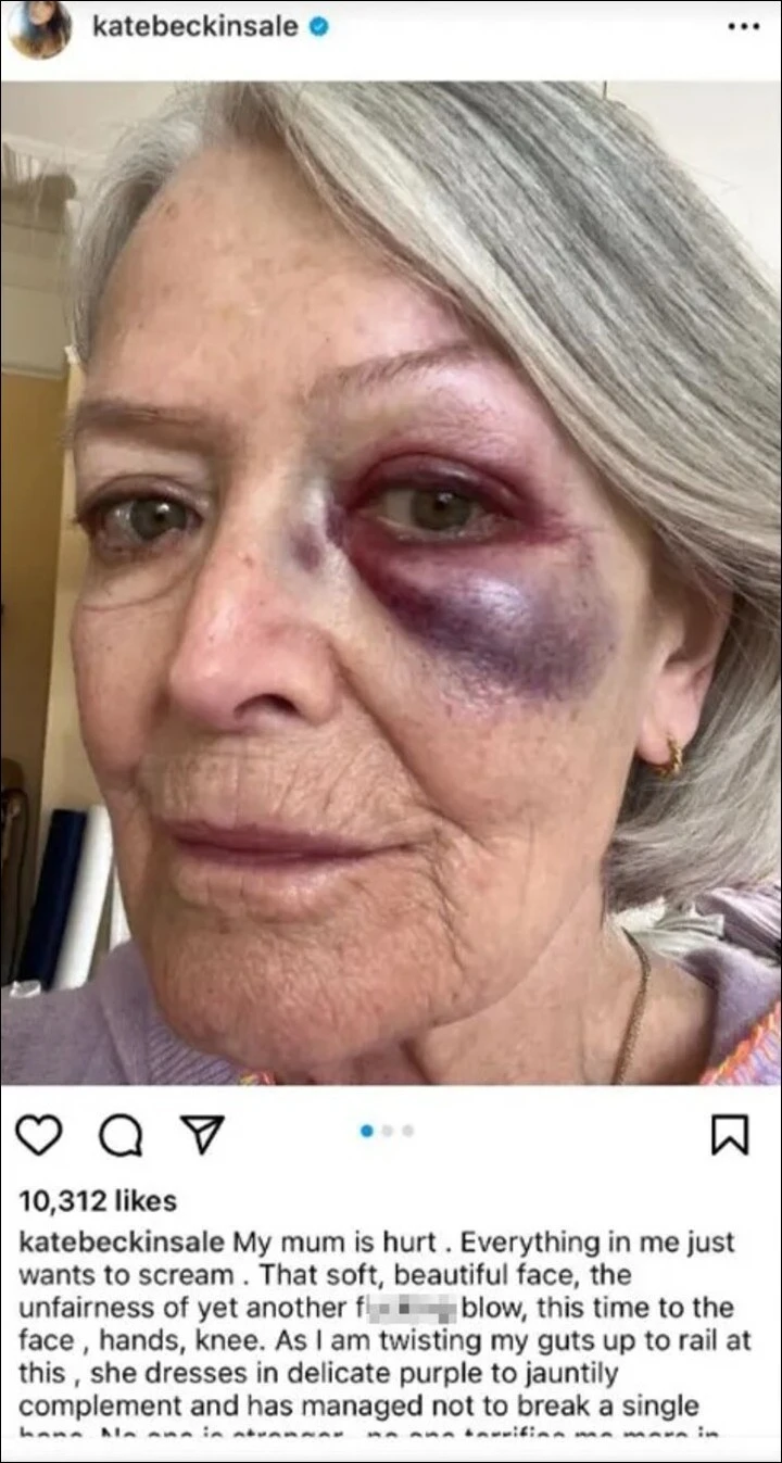 Kate Beckinsale's mom is injured