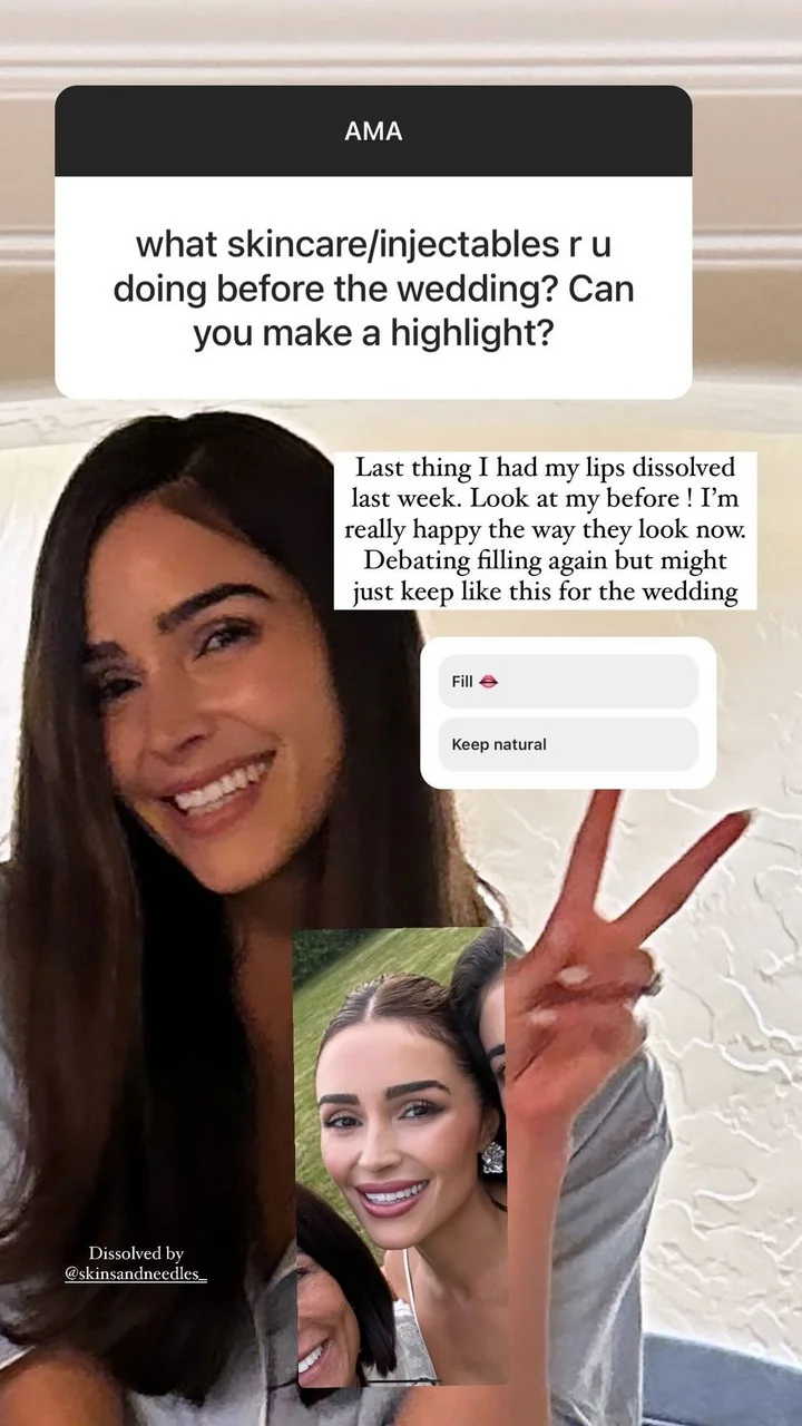 Olivia Culpo has her lip filler dissolved