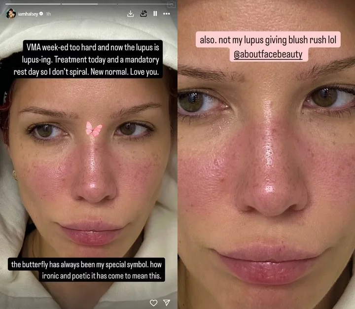 Halsey suffers lupus flare-up after VMAs