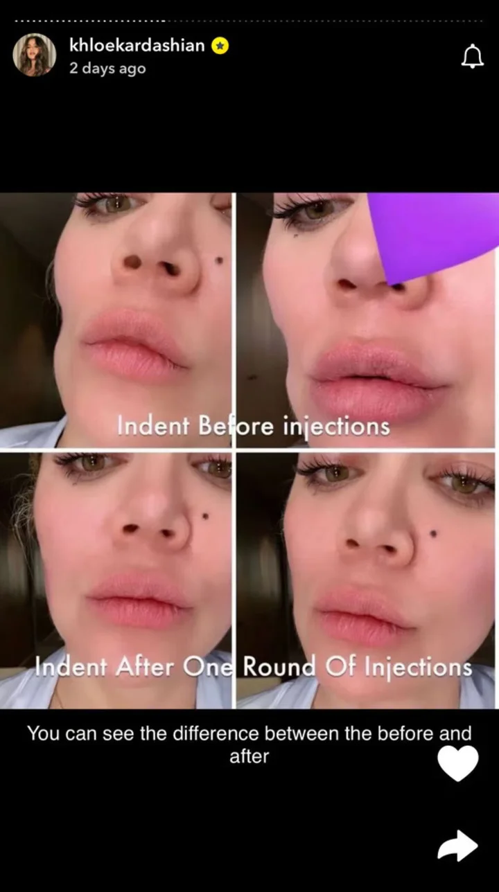 KhloÃ© Kardashian before and after fillers