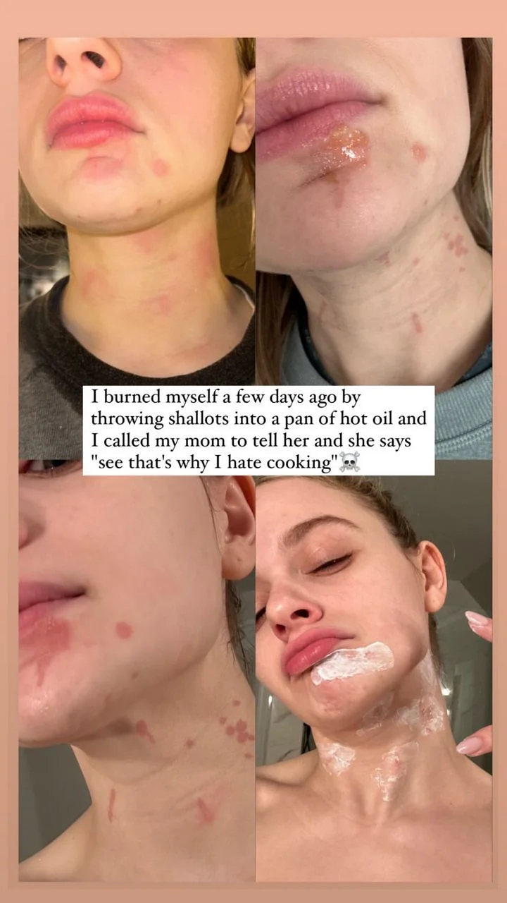 Joey King shares pictures of her face after cooking accident