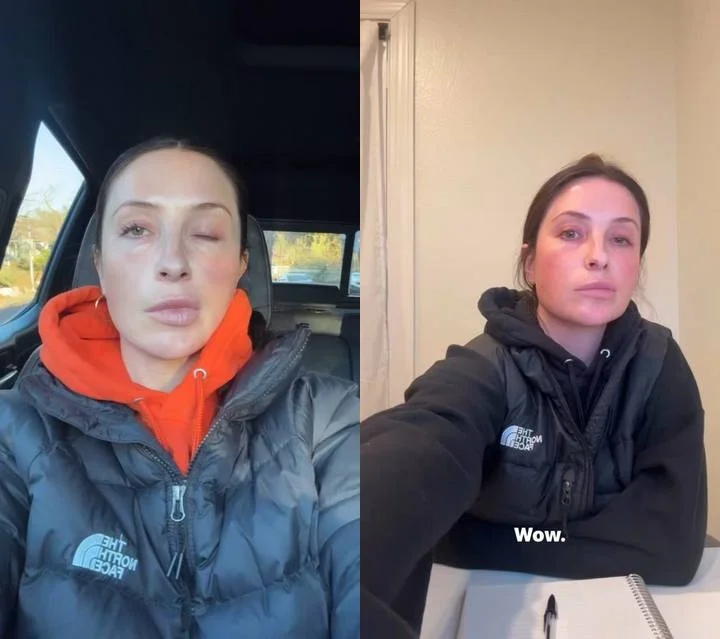 Bristol Palin opens up about her facial paralysis