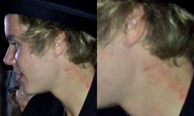 Justin Bieber Sporting Love Bites on His Neck