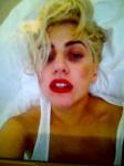 Lady GaGa Tweets Picture of Black Eye While Recovering From Concussion