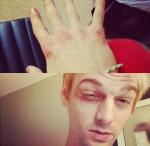 Aaron Carter Sports Black Eye Following Fight With New Kids On The Block's Fans